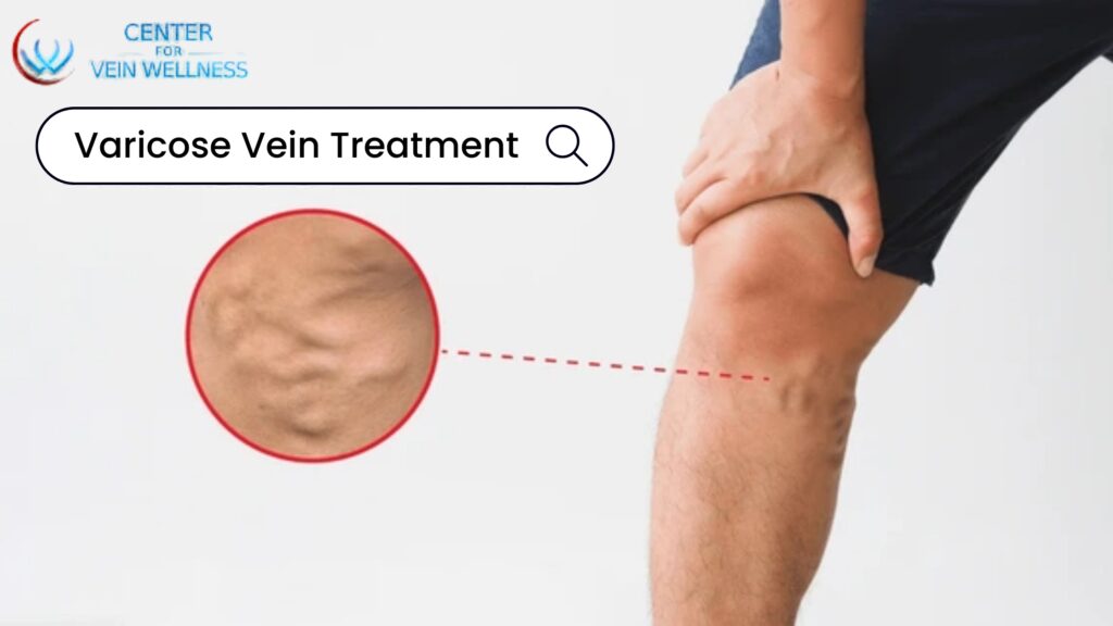 varicose vein treatment
