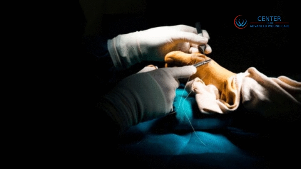 Doctor doing bunion wound surgery on foot