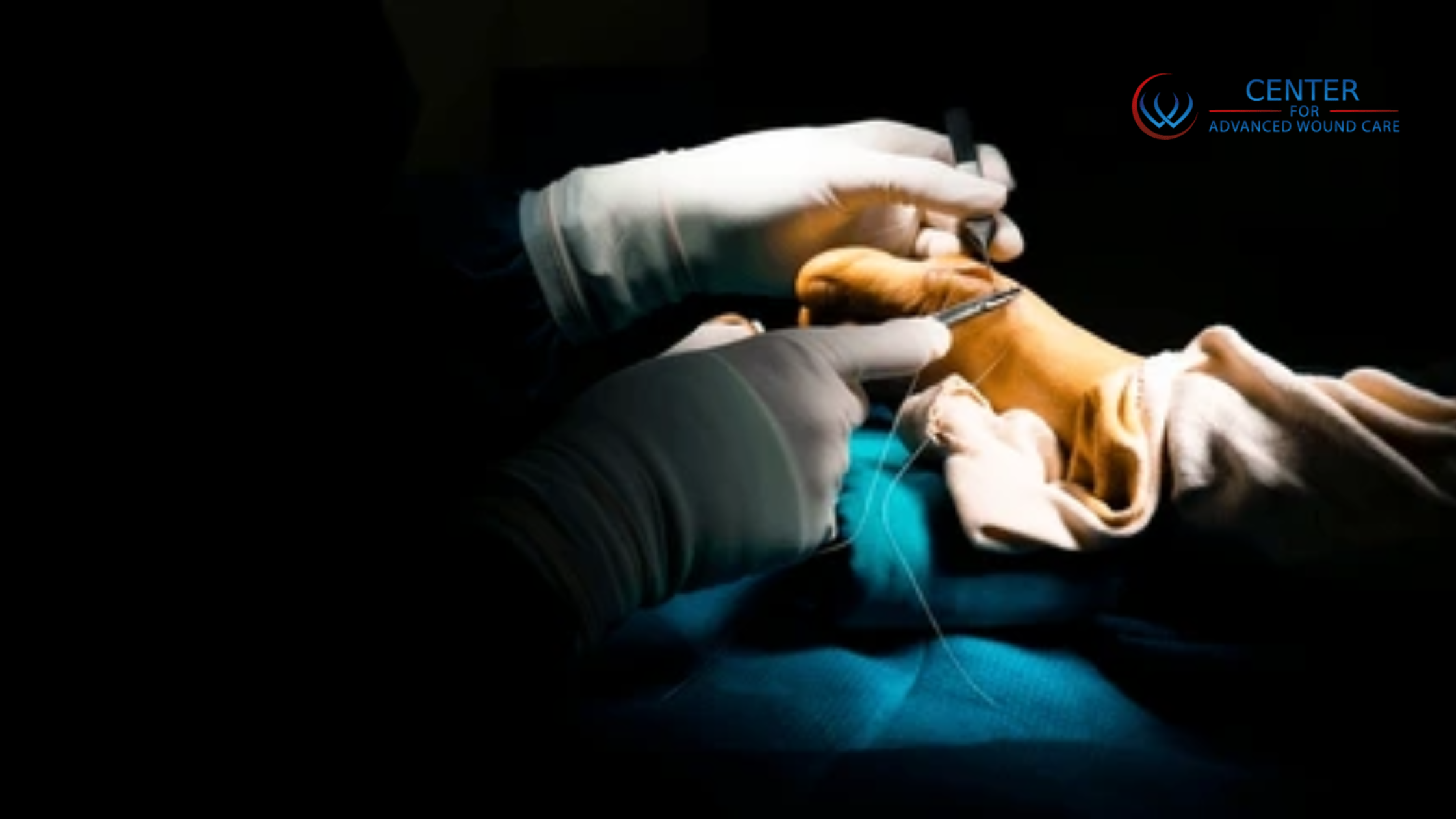 Doctor doing bunion wound surgery on foot
