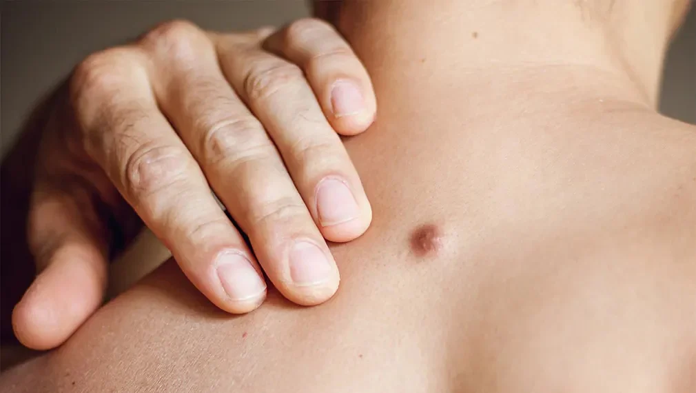 A close-up of a person’s back showing a small raised bump or cyst near the shoulder, with a hand gently touching the area.