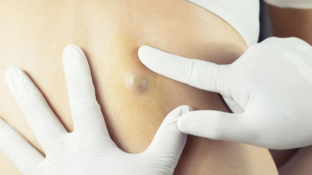 Healthcare professional examining a small sebaceous cyst on a patient’s skin while wearing medical gloves.