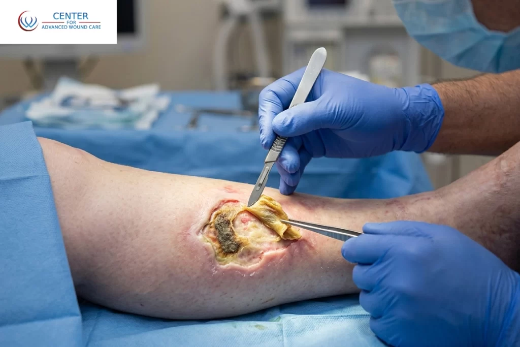 Healthcare professional performing excisional debridement on a chronic leg wound using surgical instruments to remove dead tissue and promote healing