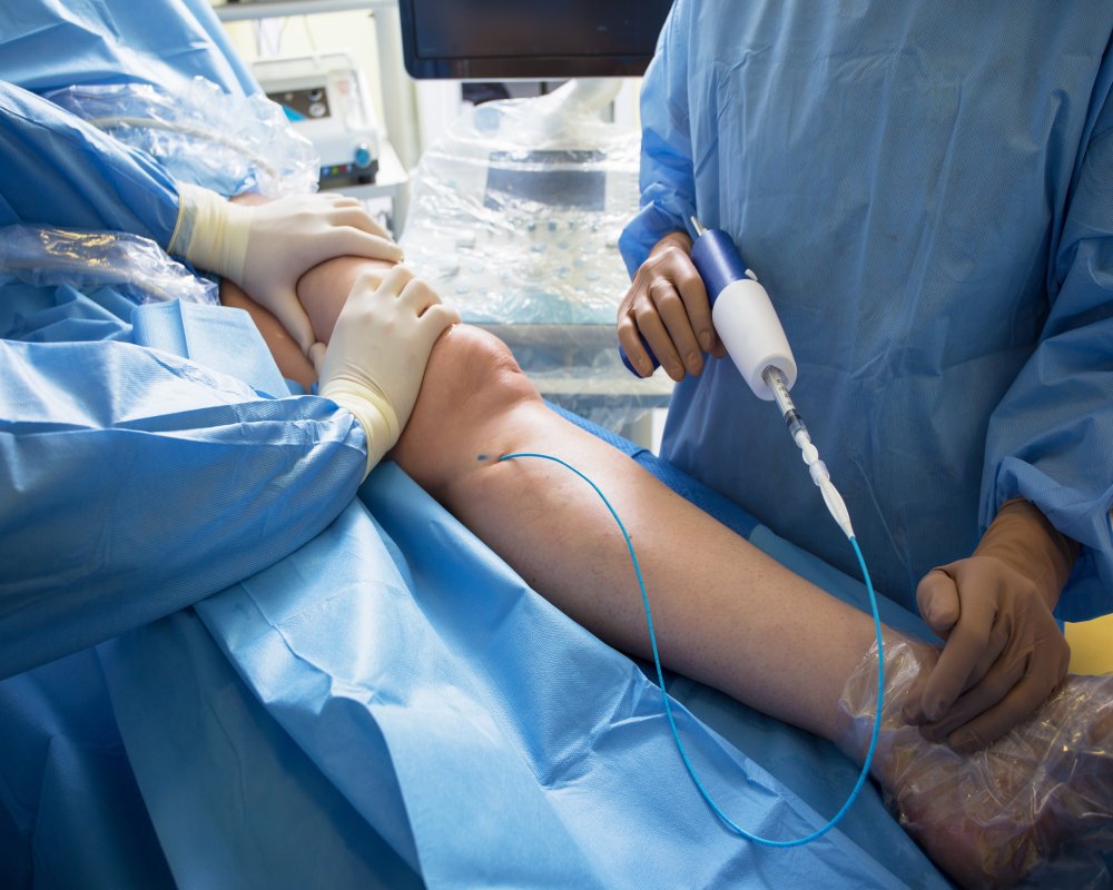 Endovenous laser ablation treatment of a leg