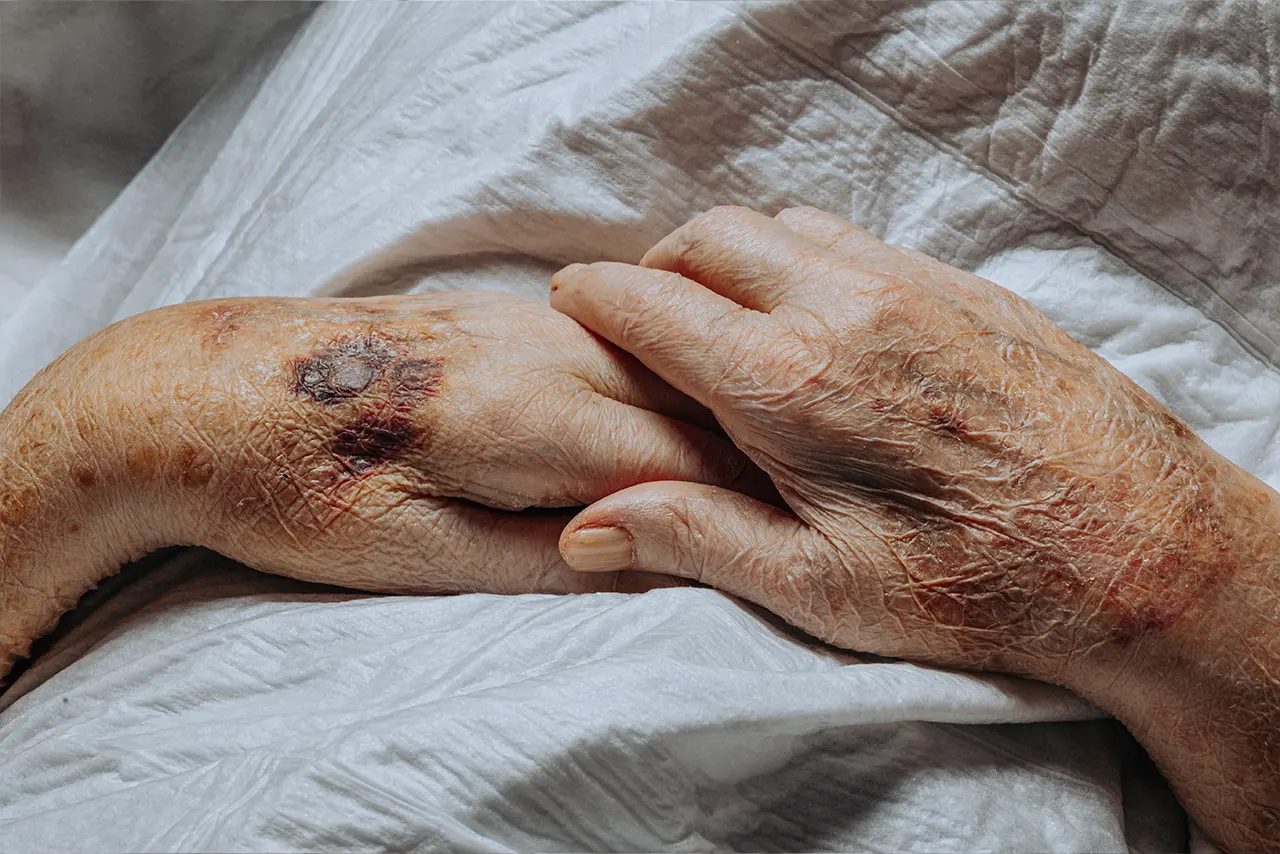 Treatment and wound care for a pressure ulcer