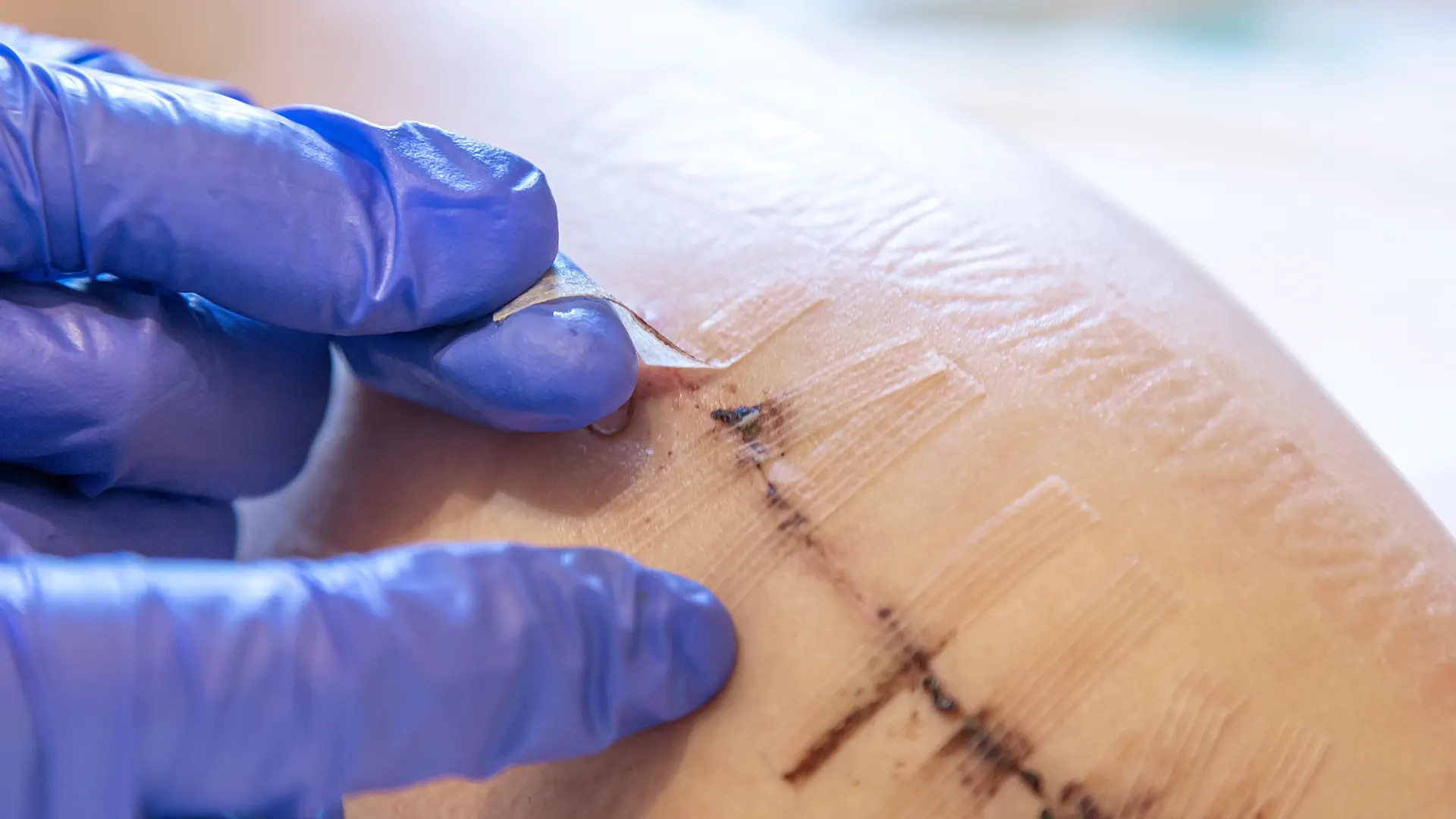 Clinician applying advanced wound treatment to a chronic wound