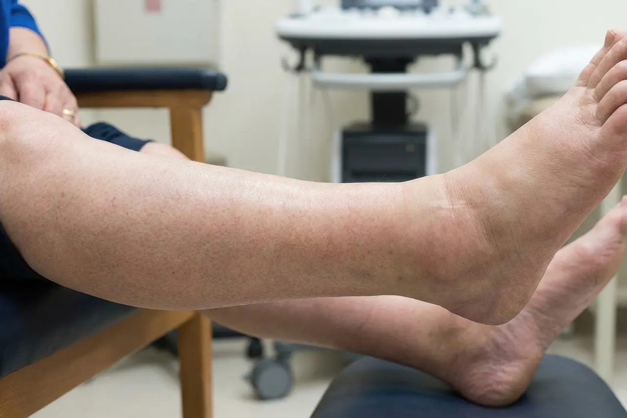 Symptoms of lymphedema in the lower extremities