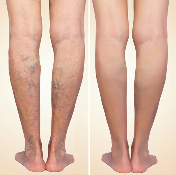 Spider veins and chronic venous disease