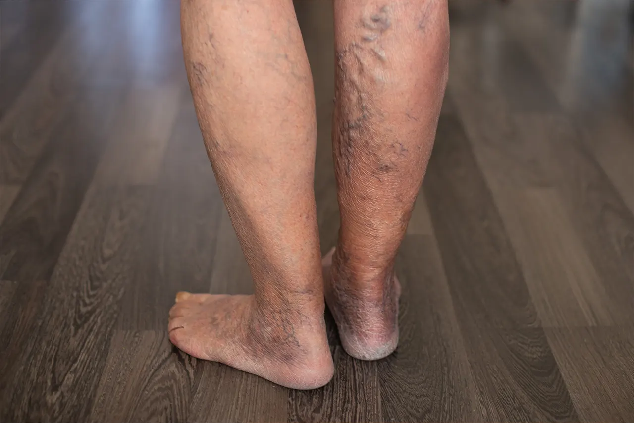 Evaluation and treatment of varicose veins