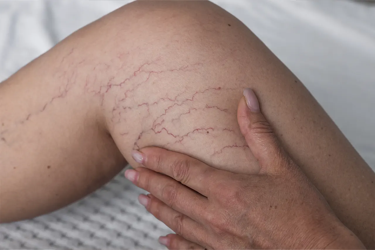 Cosmetic vein treatment consultation