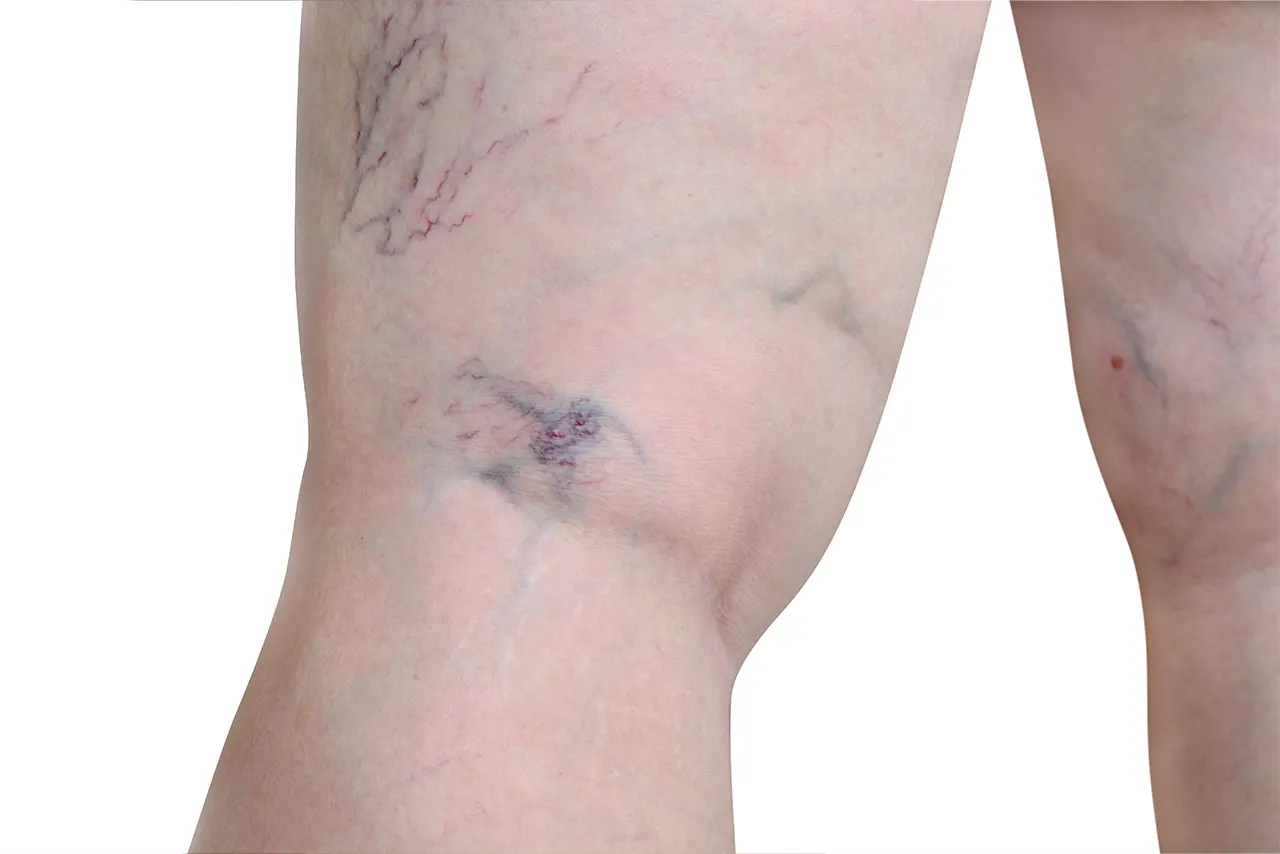 Provider performing precision vein treatment
