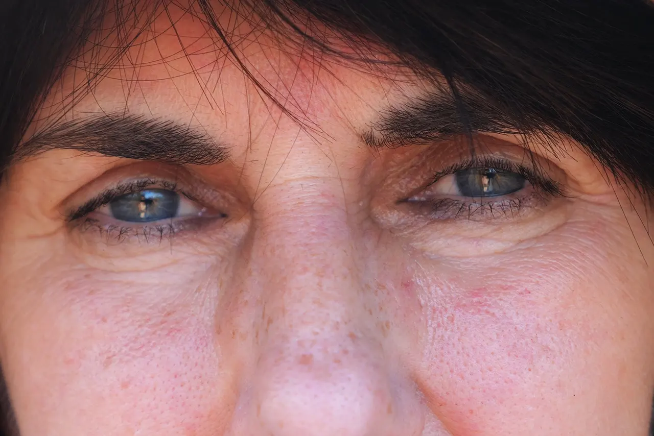 Facial veins visible on the leg