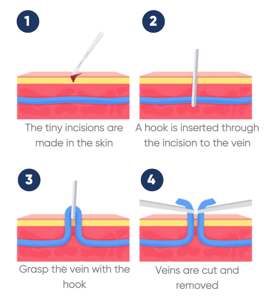 Minimally invasive varicose vein treatment