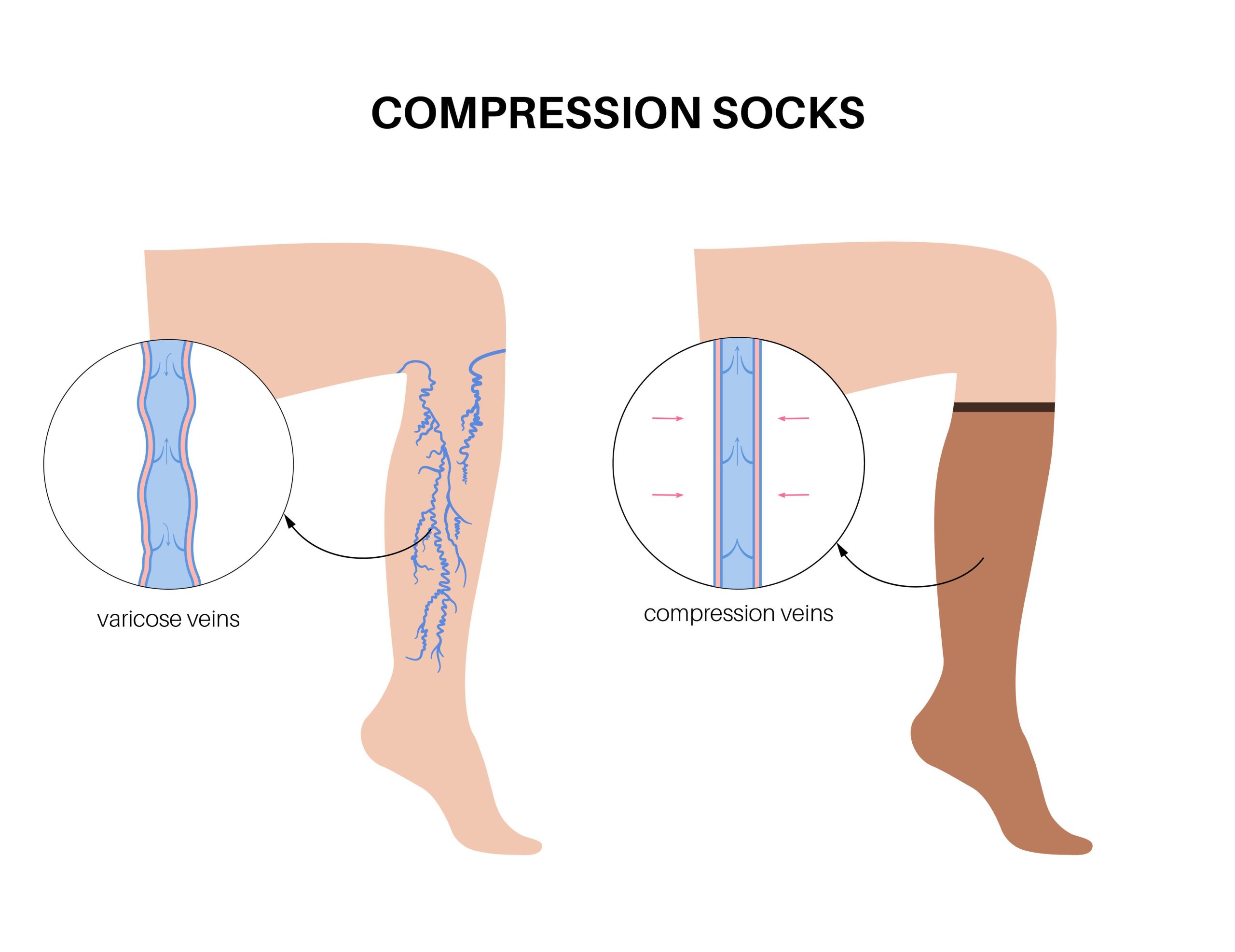 Medical compression stockings and venous treatment