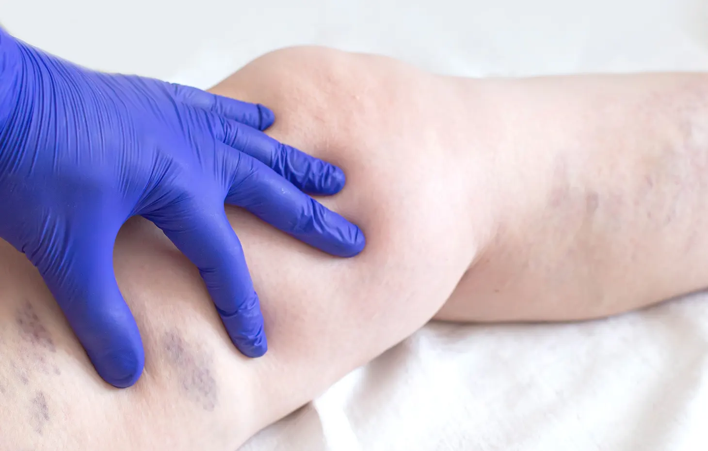Ultrasound-guided minimally invasive vein procedure