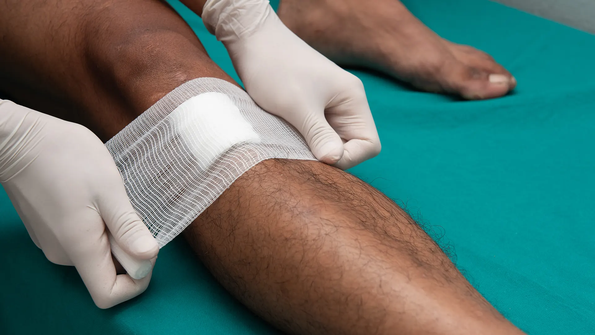 Clinical wound care for a lower leg ulcer
