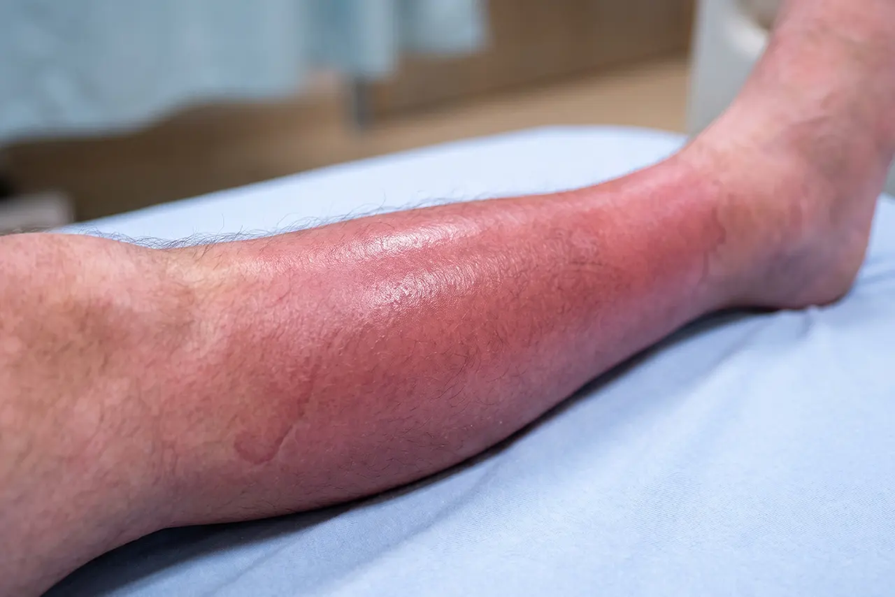 Evaluation and treatment for leg swelling