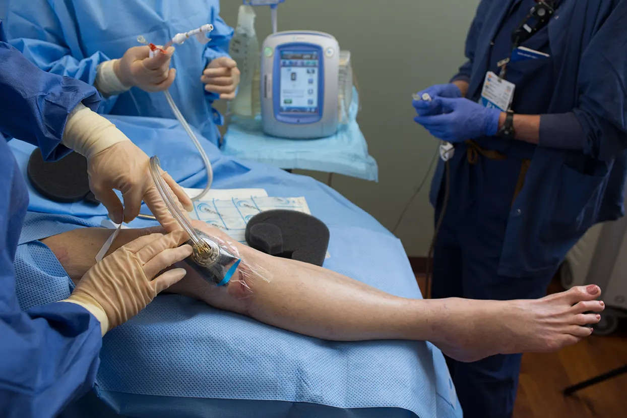 Negative pressure wound therapy being applied to a lower leg wound