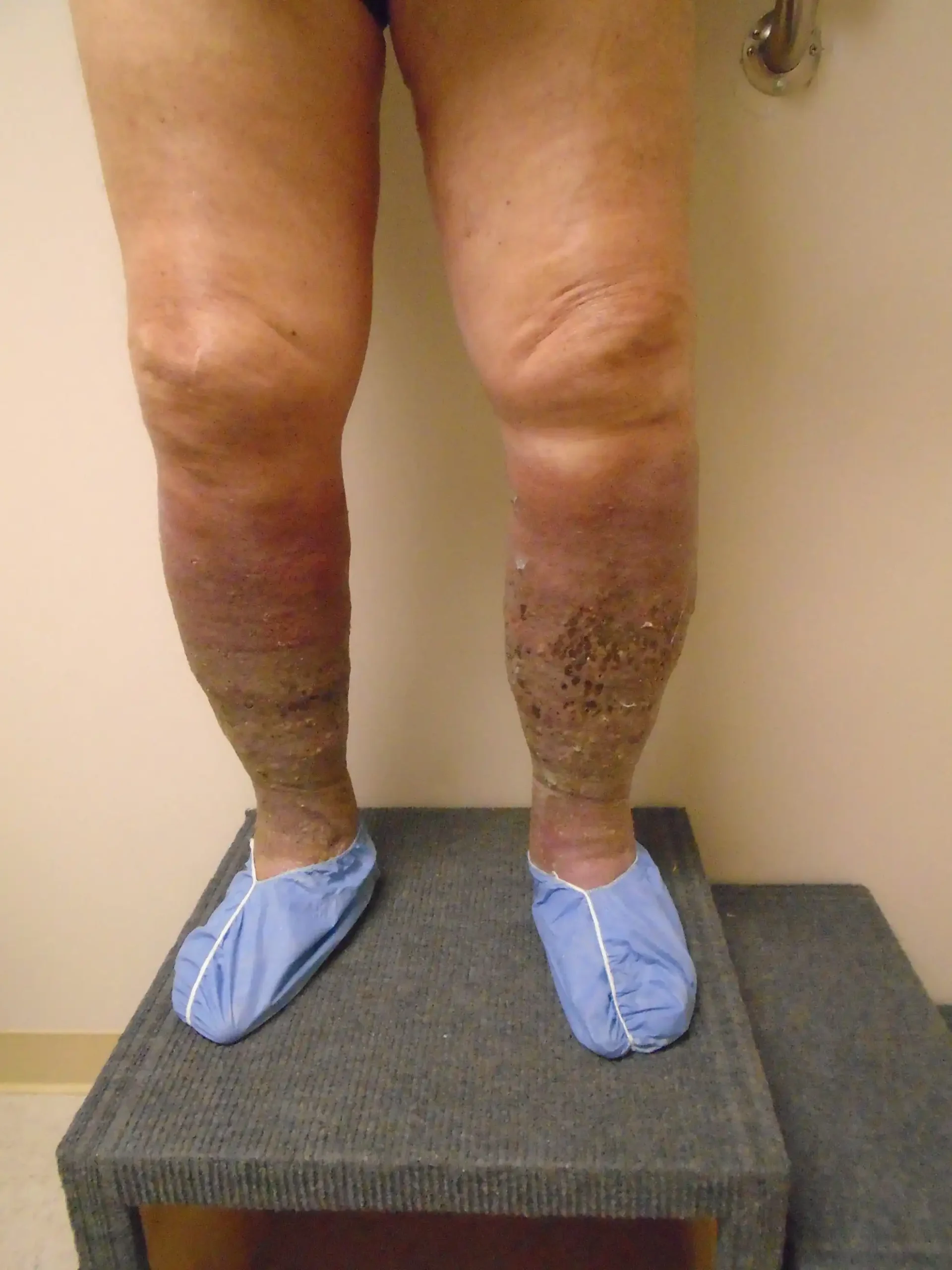 Chronic venous insufficiency evaluation