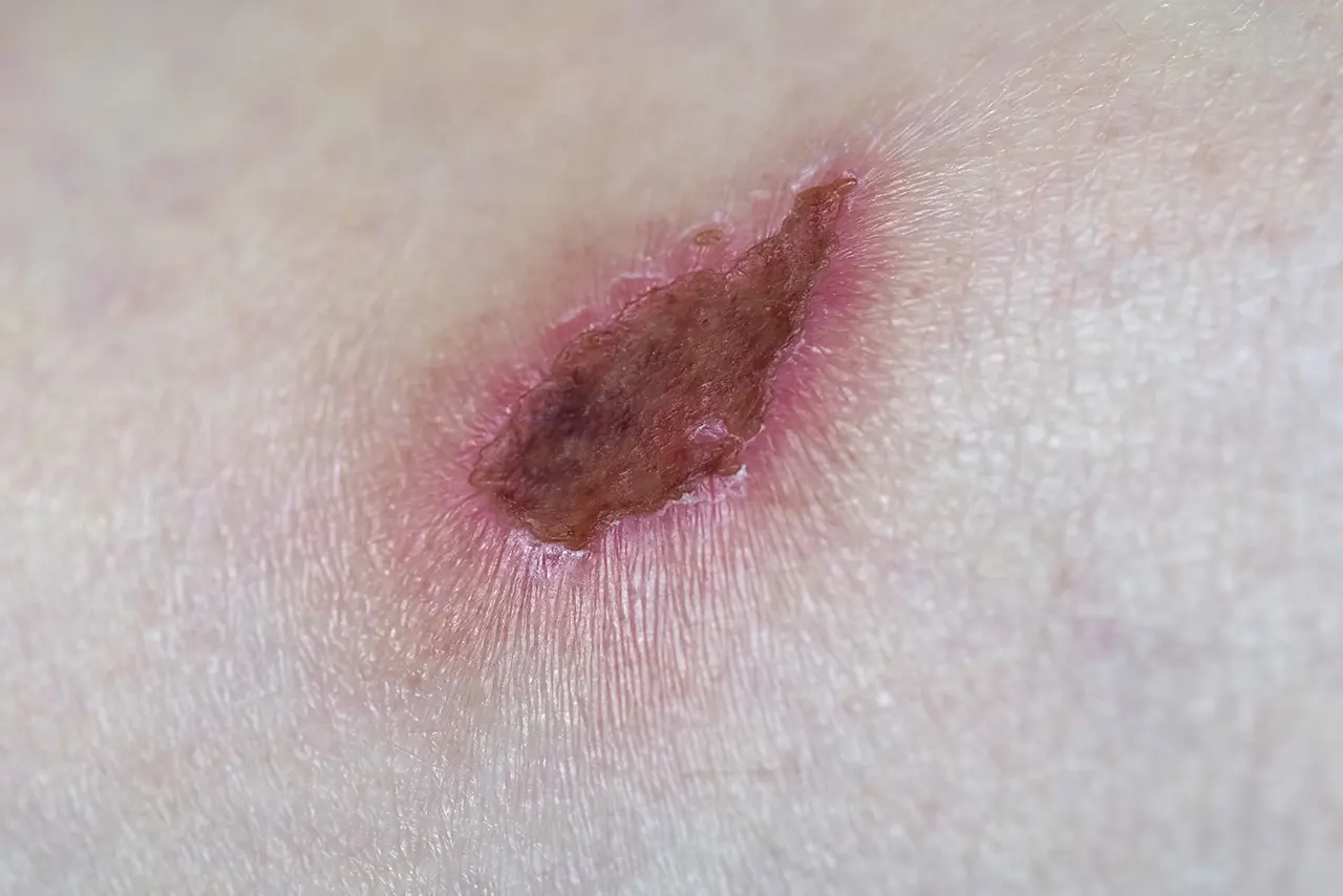 Evaluation and treatment of an infected wound