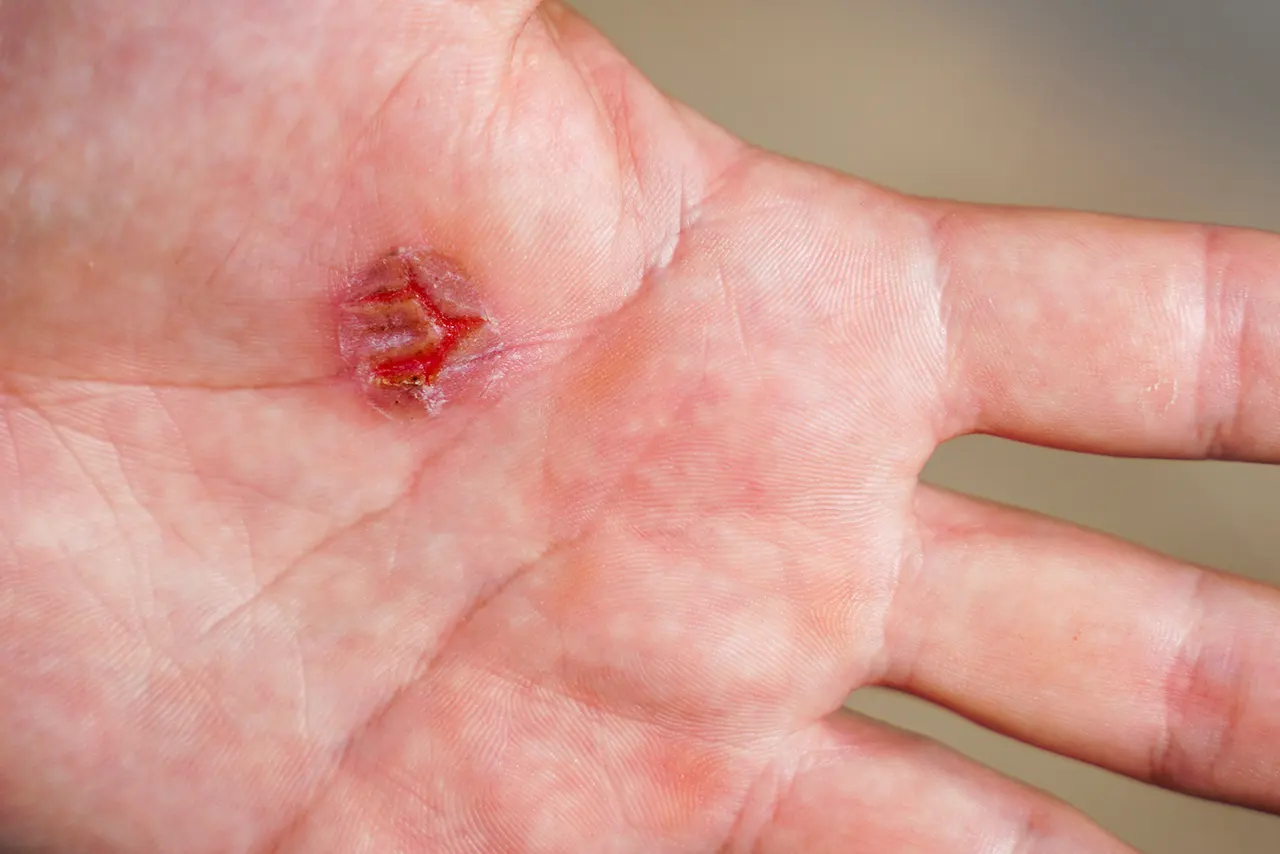 Signs and symptoms of a wound infection