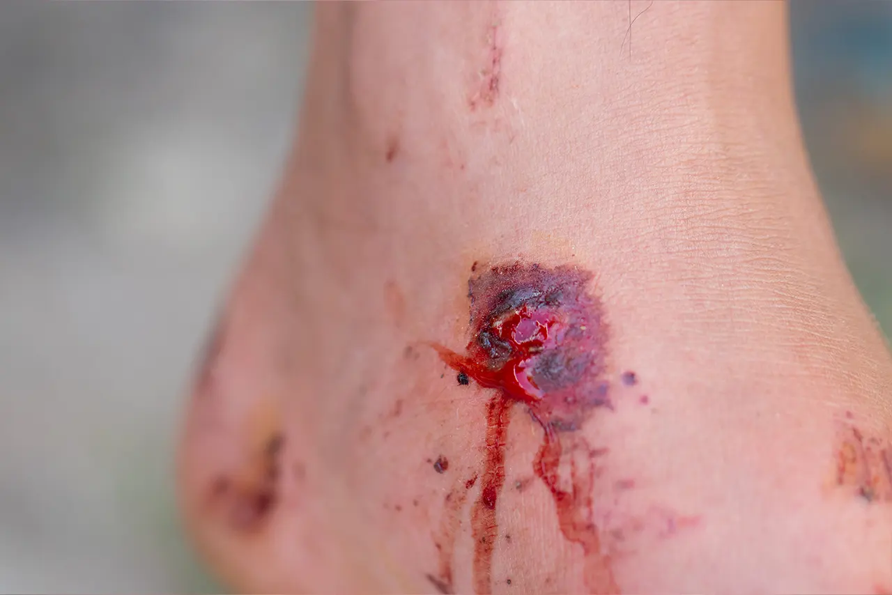 Treatment and care of an infected wound
