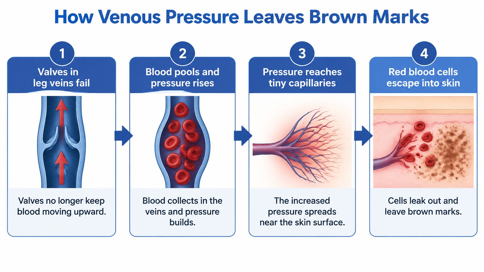A four-step medical diagram explaining how failed venous valves cause blood pooling and skin discoloration.