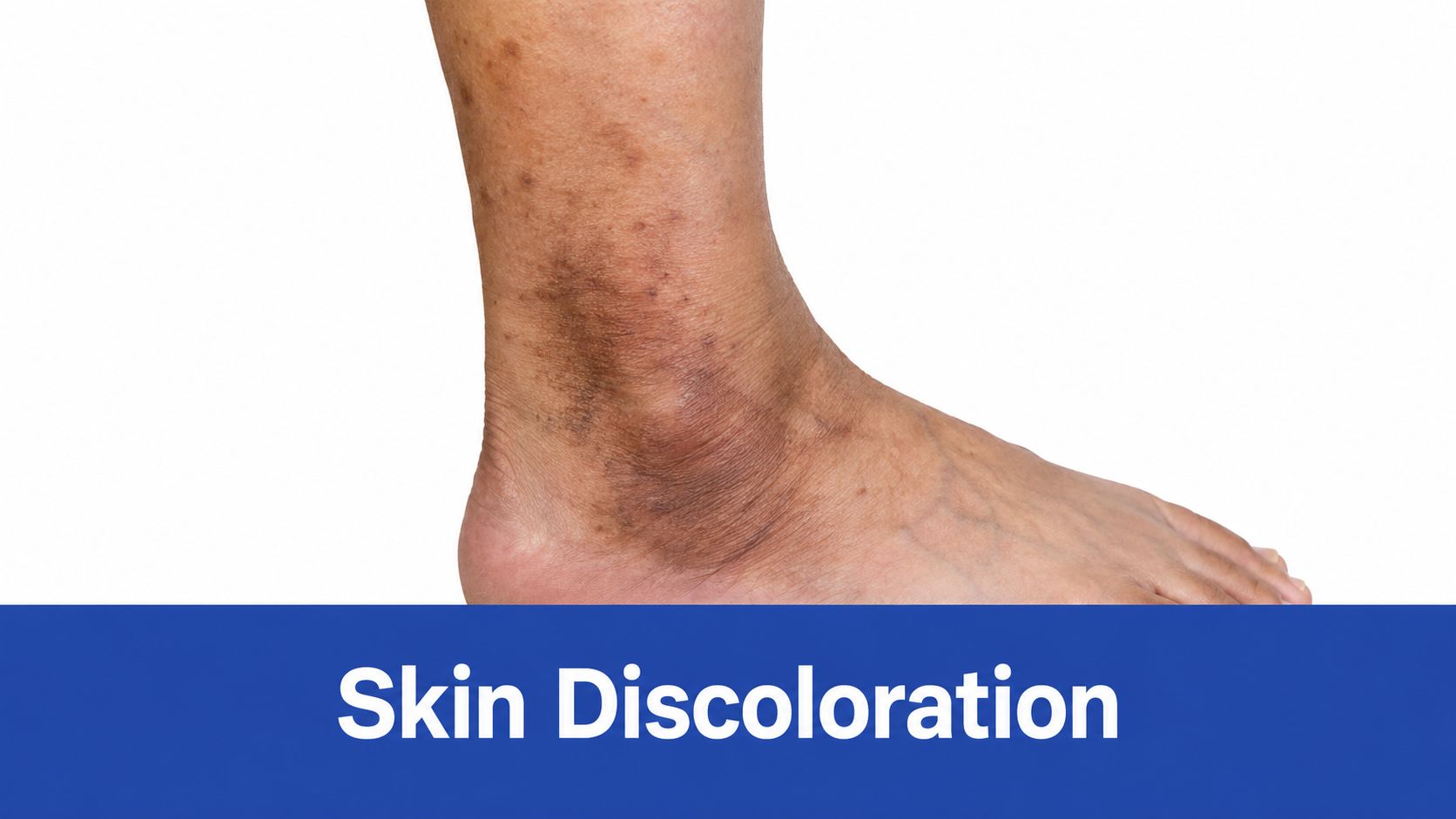 A close-up view of skin discoloration and hyperpigmentation on a person's lower leg near the ankle.