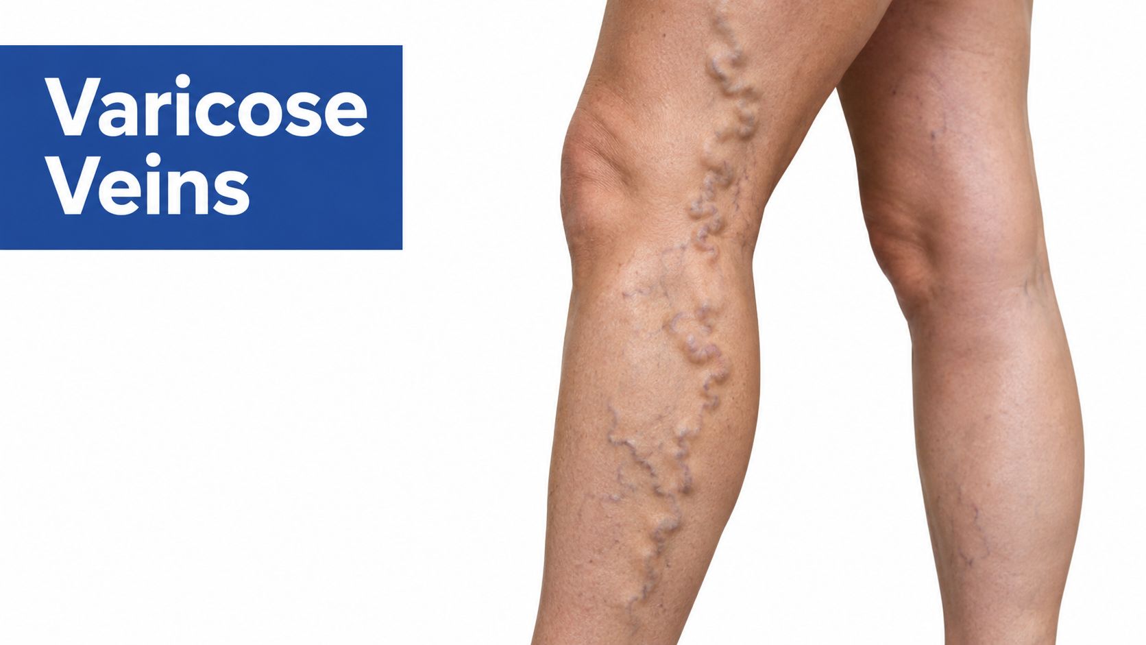 A close-up view of a human leg showing visible, twisted, and swollen varicose veins under the skin.