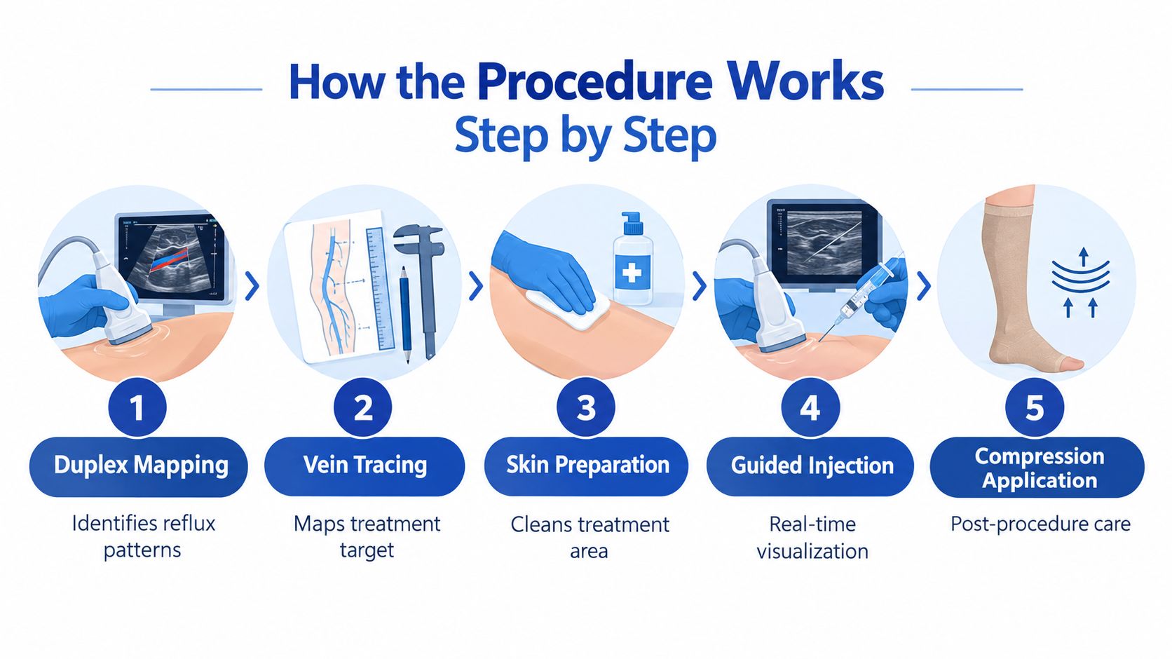 A five-step infographic showing the medical procedure for ultrasound guided sclerotherapy to treat varicose veins.