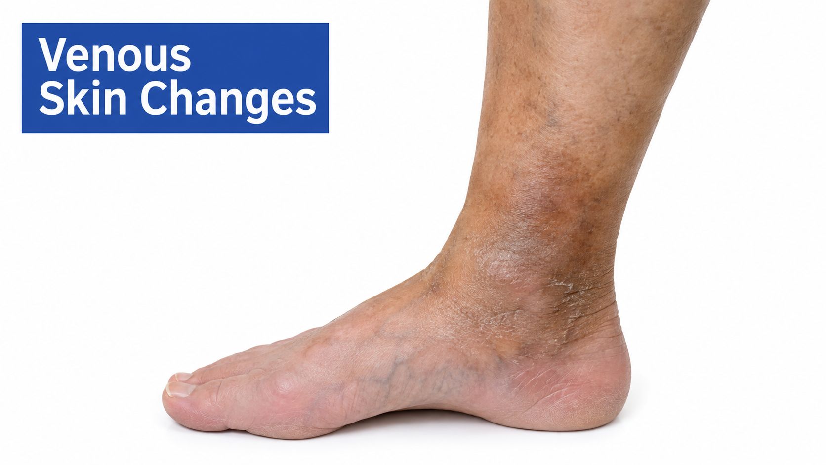 A close-up view of a human foot and ankle showing skin discoloration associated with venous insufficiency.